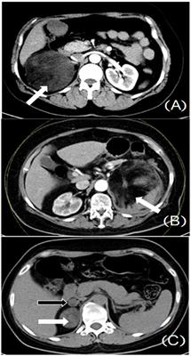 Adrenal Myelolipoma: 369 Cases From a High-Volume Center